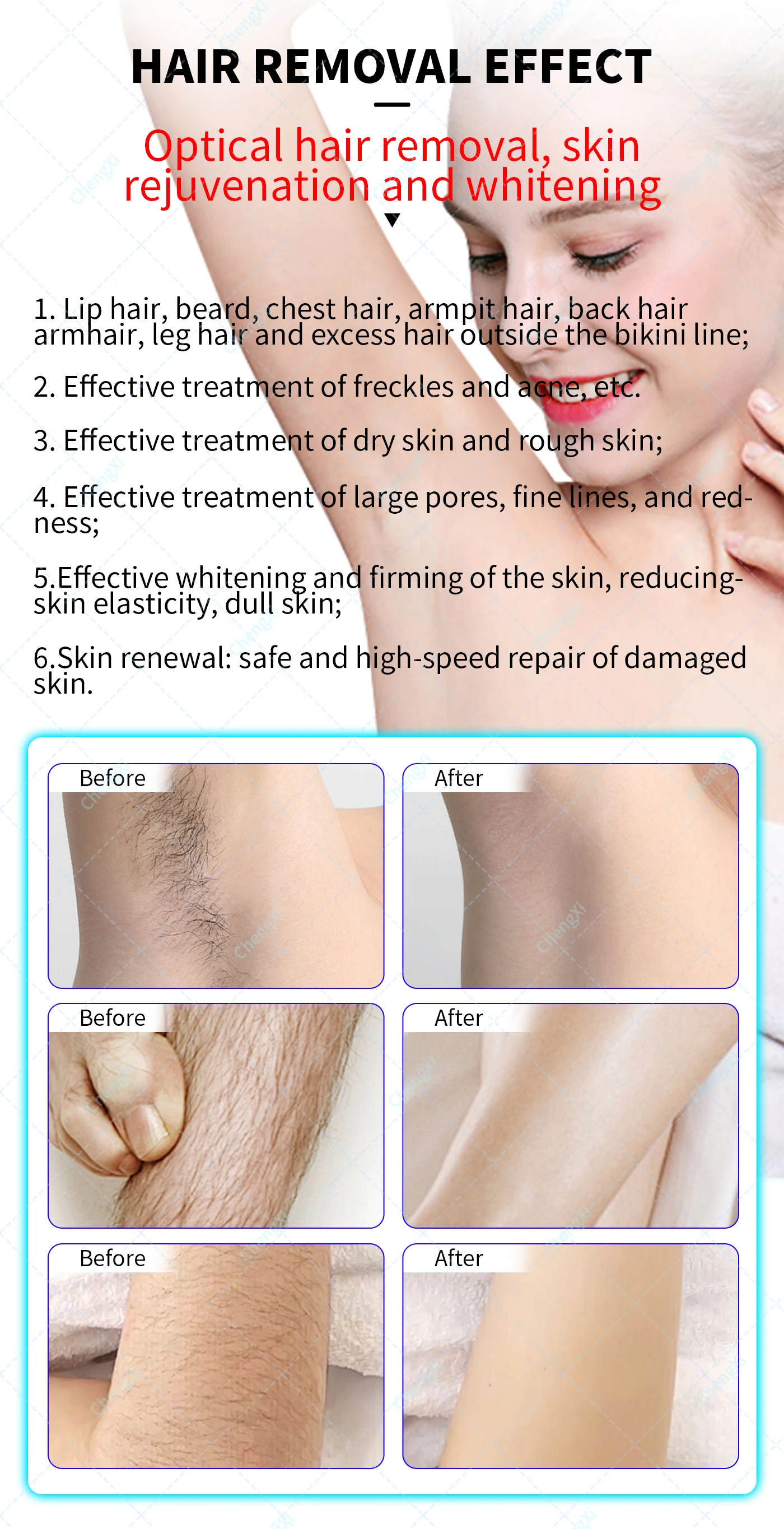 

2025 Professional Laser Diode 808 Nm/808nm Diode Laser Hair Removal Machine/diode Laser