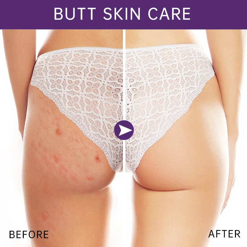 Buttock Cream Whitening Pimple Spot Remove Smoothing Lift Up Ass Firming Body Lotion Sexy Hip Women Buttock Moisturizing Cream