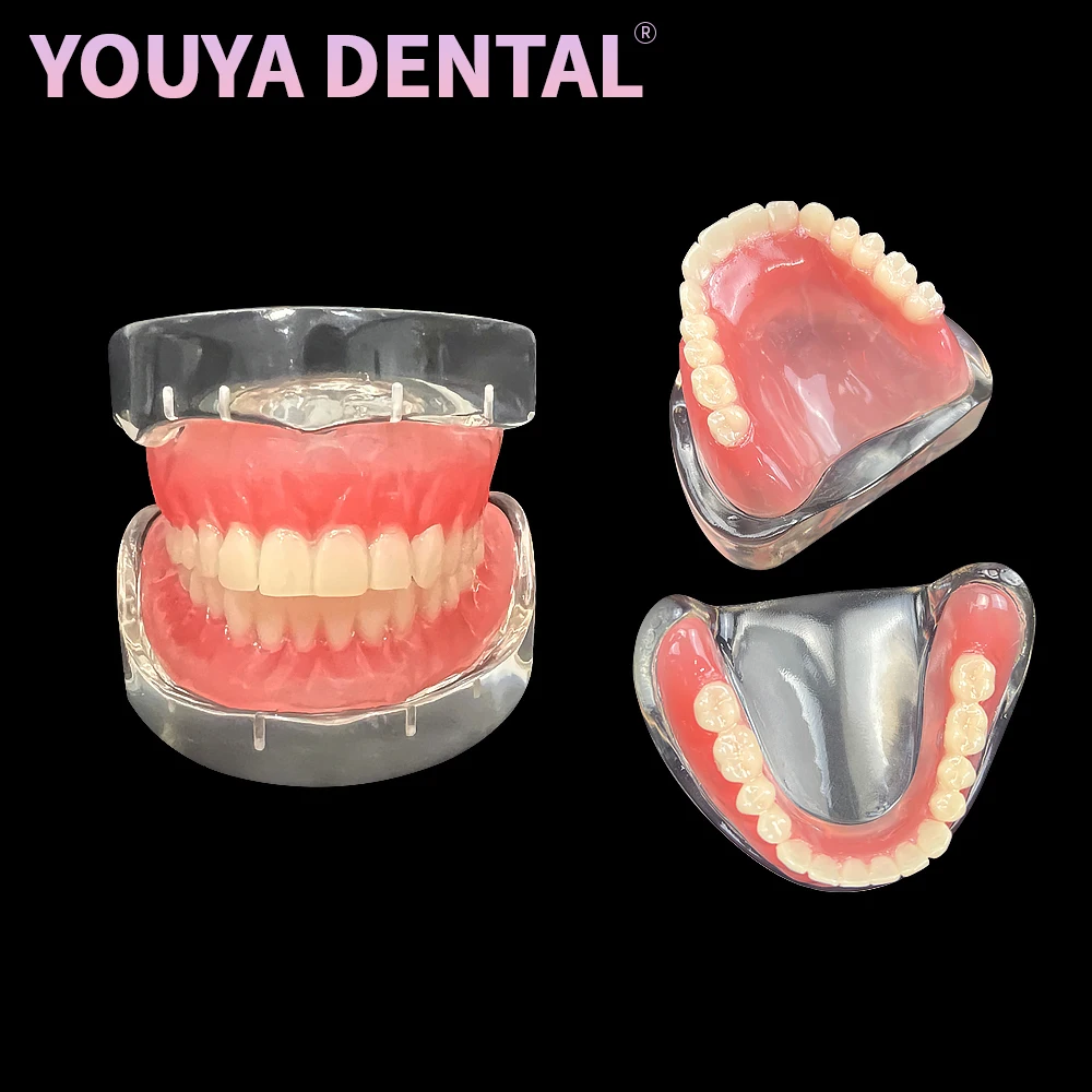 Dental Implant Model Removable Upper/Mandibular Model with 4 Implants Research Overdenture For Dentist Teaching training Demo