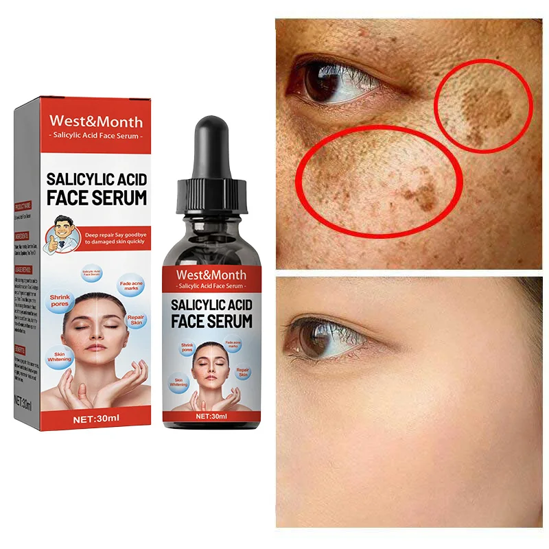 Nicotinamide Freckle Removal  Serum Attenuates Stains Facial Salicylic Acid Shrinks Pores  Moisturizes Face Skin Care Products