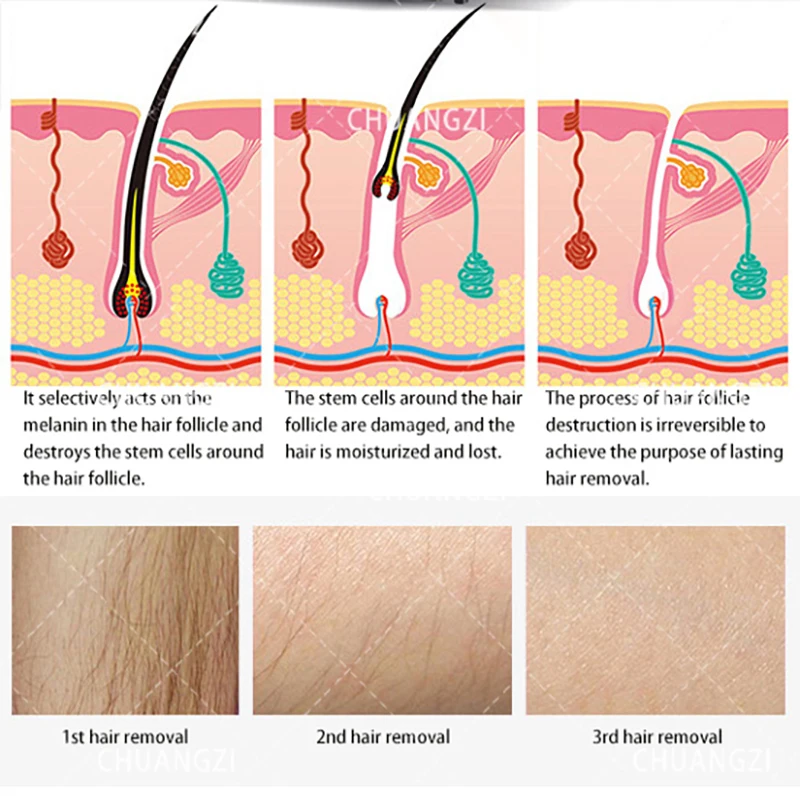 جهاز إزالة الشعر بالصمام الثنائي ذكي 3 أطوال موجية 808 نانومتر 755 نانومتر 1064 نانومتر نظام تبريد نقطة التجميد يستعيد البشرة الناعمة الحريرية