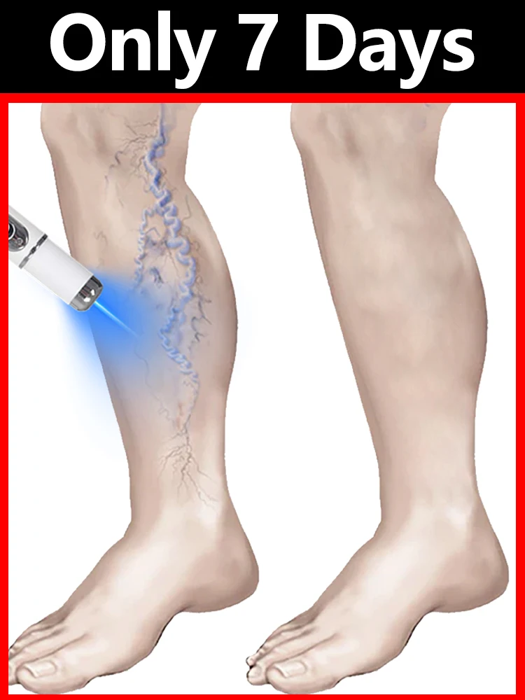 

Комбинированный набор инструментов для синего света с венами. Пакетные инструменты. Можно приобрести индивидуально или в сочетании. Отпродукты, чтобы «Пауковые ноги»