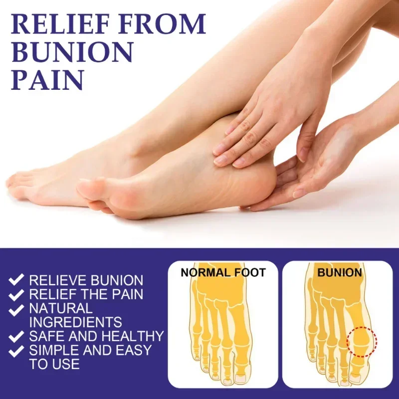 Sdotter New 5pcs Anti-bunion patch foot care relieves swelling pain hallux valgus Corrector Orthotics Feet Bone Thumb Adjuster T