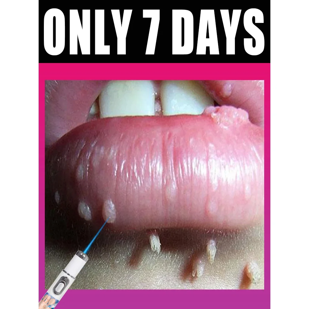 

Лазерная ручка с синим светом: попрощайтесь с бородавками, инструмент для гладкой кожи, от нитевидных и плоских бородавок BHL176-cat