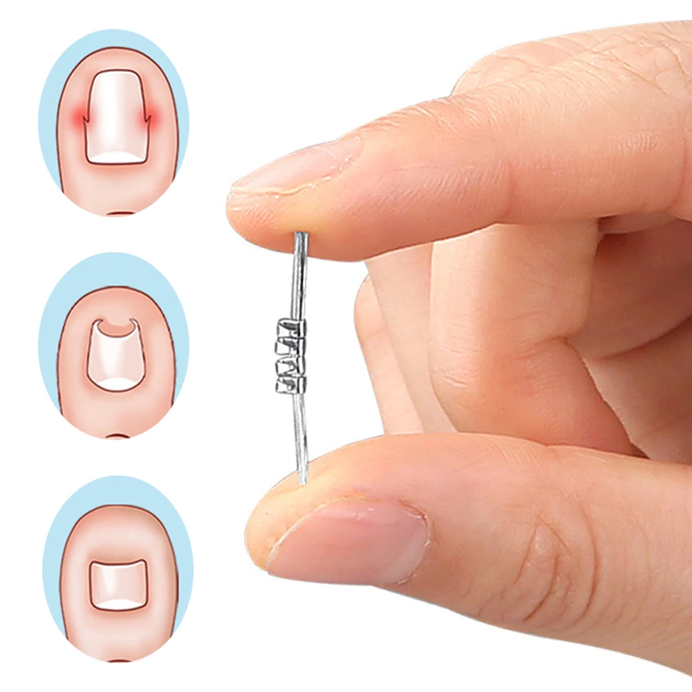 

Ingrown Toenail Pedicure Tool Embed Toe Nail Care Straightening Correction Clip Curved Clamp Toenails Correction Tool