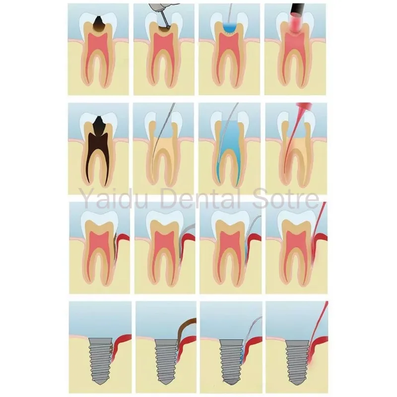 Wireless 650nm Dental Laser Pointer Low Light Infrared Oral Disinfection Pulp Periodontal Implant Repair Tool for Dental Care