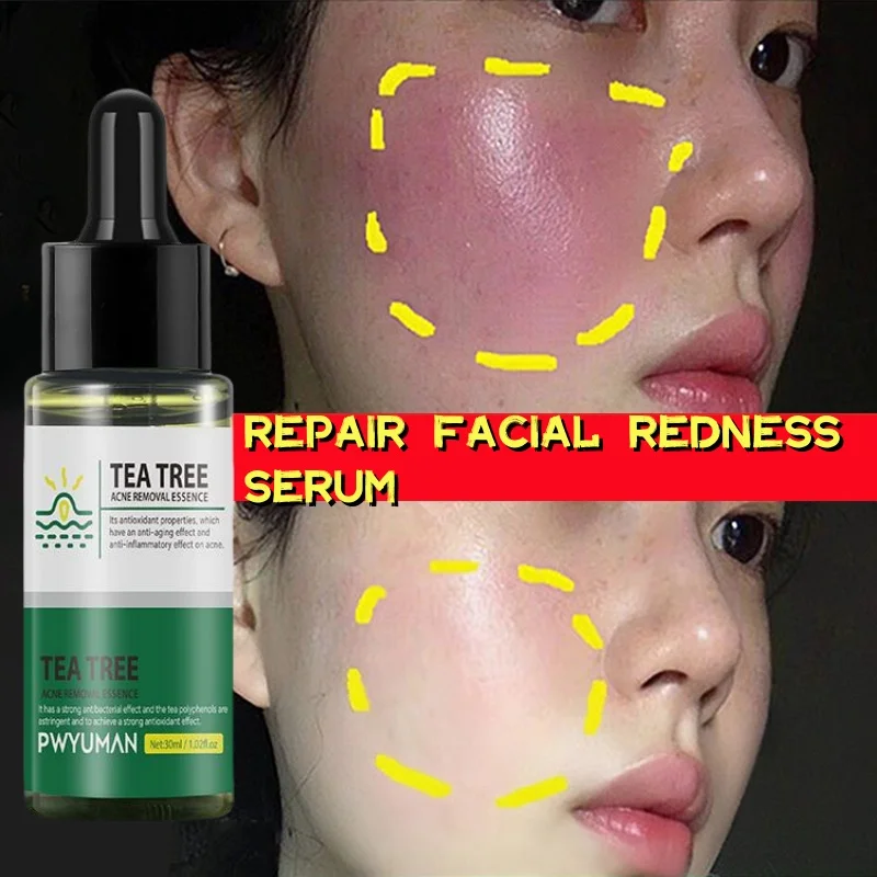 

Repair Facial Redness Serum Instant Spider Vein Remove Sensitive Skin Sooth Anti Redness Rosacea Treat Lotion Korean Cosmetics