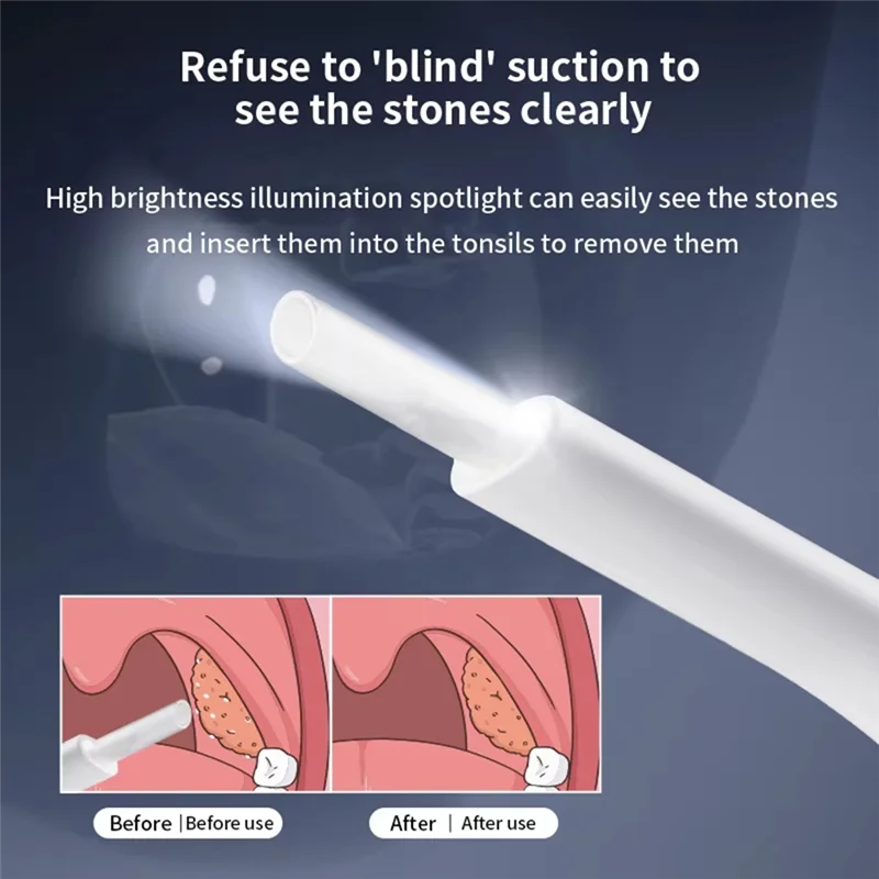 

A21I-Электрический набор для удаления камней из миндаля, вакуумный набор для удаления камней с миттєвым всасыванием, удаление камней из миндаля