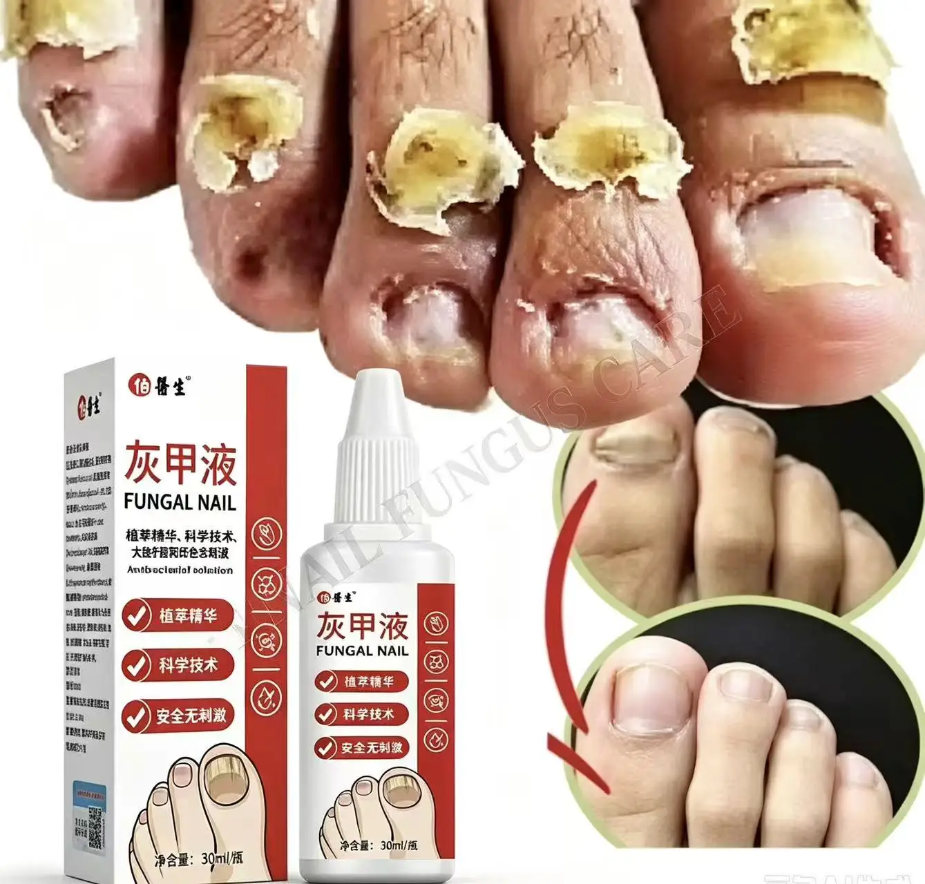 Nail Fungal Treatment Serum Onychomycosis Paronychia Anti Infection Toe Fungus Hand Foot Removal Repair Gel Care Beauty Health