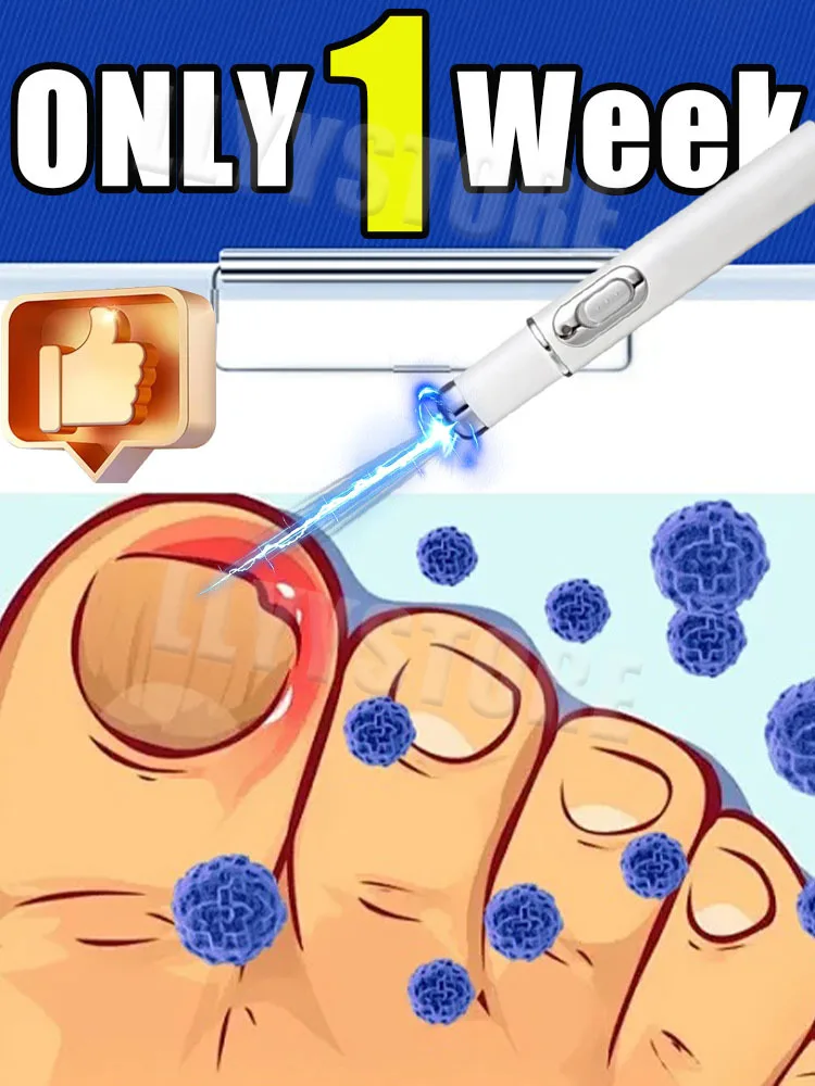 

New technology laser pen helps your nails regain health