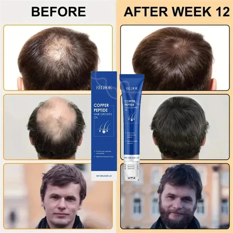 إنتاج Nsucciss،99% des acheteurs acheteurs achéteront ànouveau، its ont de plus en plus de cheveux، disent Alfa à la calvitie، Cheveux épais
