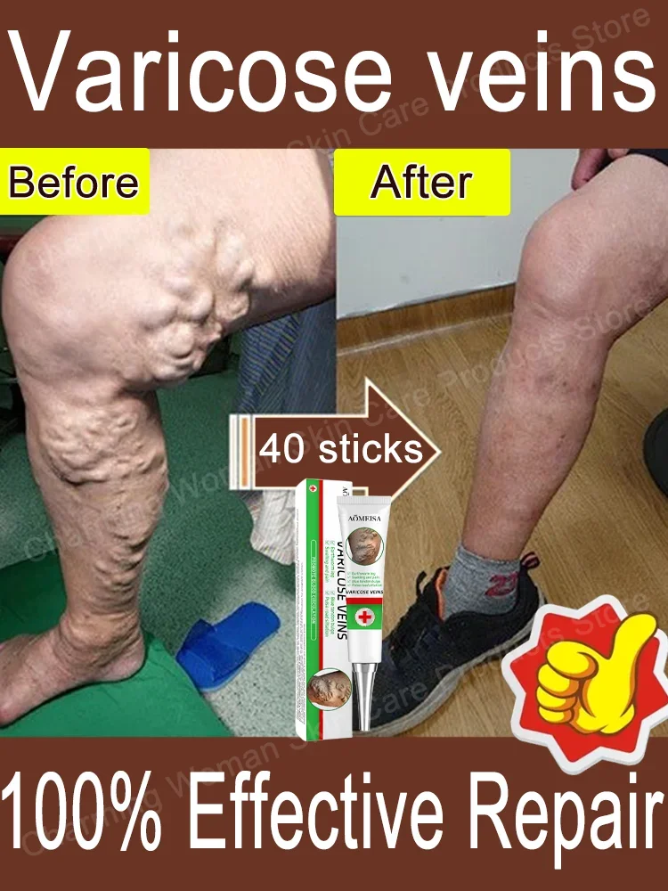 Gel to relieve varicose veins, relieve lumps in legs