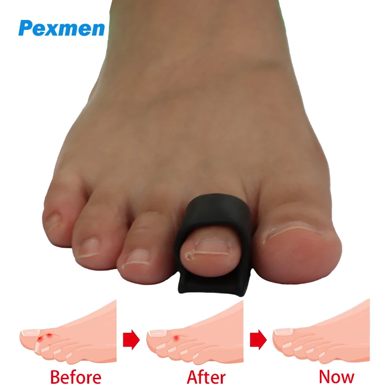 Pexmen 2/4Pcs Hammer Toe Corrector Hammertoe Straightener for Curled Crooked Bent Claw and Overlapping Toes Bunion Pads