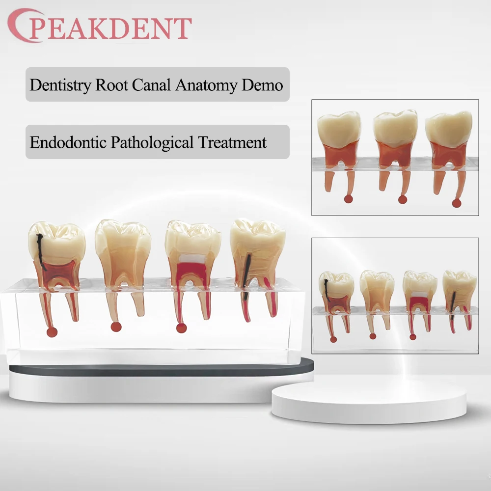

1pcs Dental Teeth Model Endodontic Caries Treatment Clear Demonstration Model for Dentistry Root Canal Anatomy Clear Study Demo