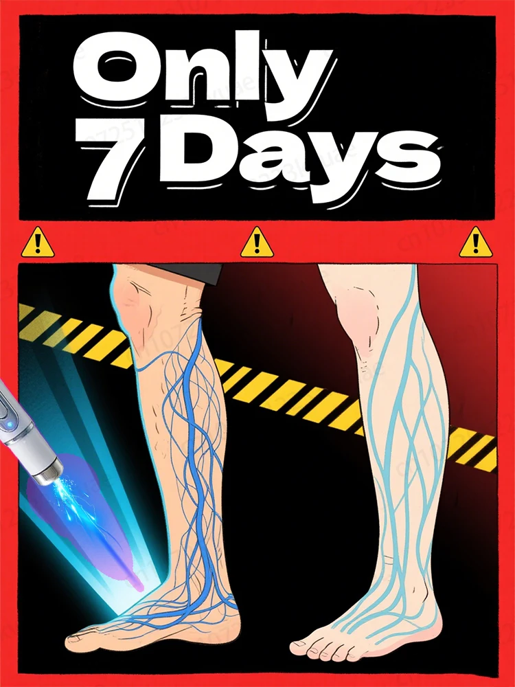 

Generation-2 Laser Says Goodbye To Spider Legs Varicose In 7 Days