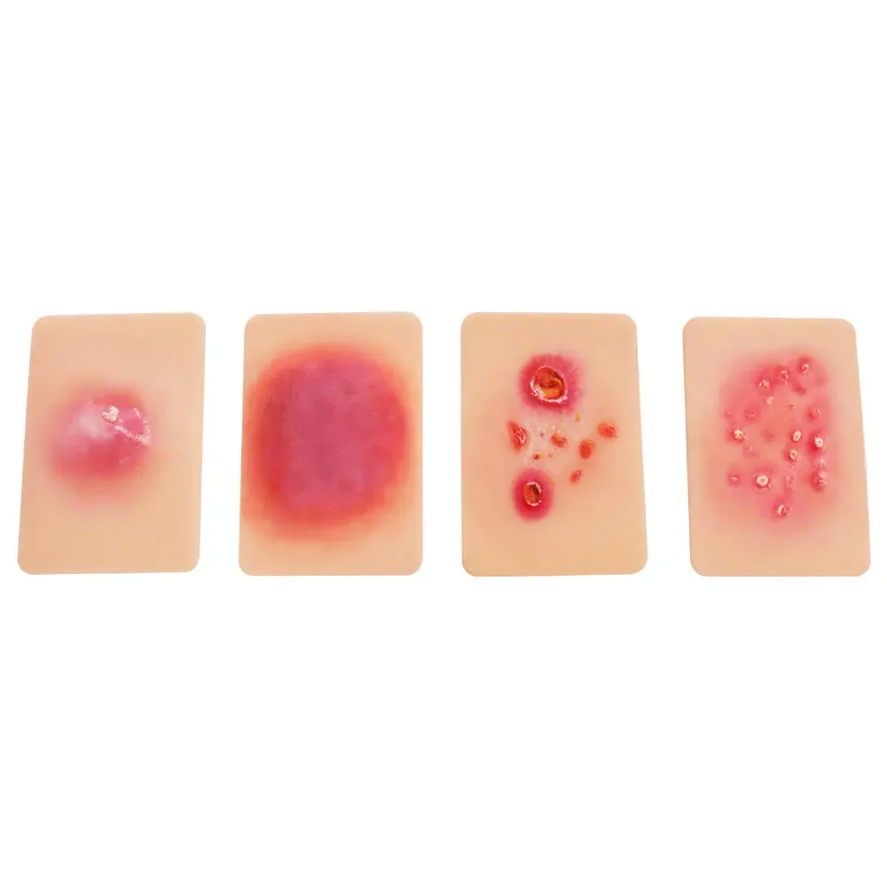 Ultrassist Bacterial Skin Infection Wound Models (Set of 4) Card-Sized for Medical Education Dermatologist Presentation Tools