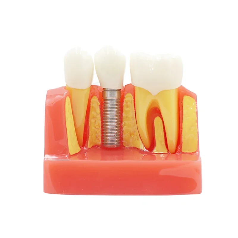 Dental 4 times planting Teeth model Analysis Crown Bridge Removable Model Dental Demonstration Teeth Model