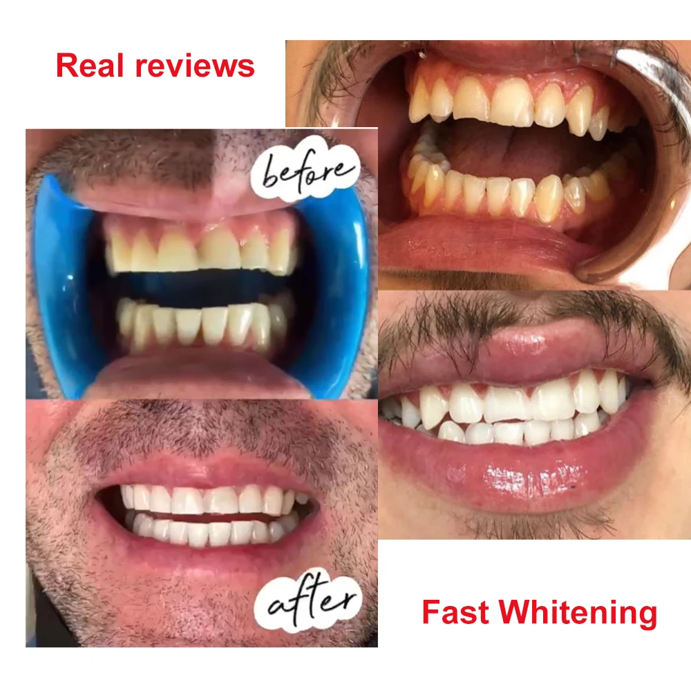 Dental Whitening Kit Teeth Whitening Bleaching Gel Kit Powder for Professional LED Lamp Teeth Whitening Bleaching