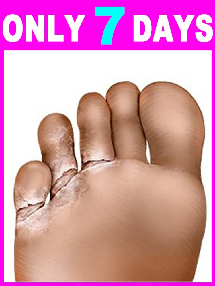 

Fᴏᴏᴛ Fᴜɴɢᴜs Eʟɪᴍɪɴᴀᴛɪᴏɴ Specifically for feet