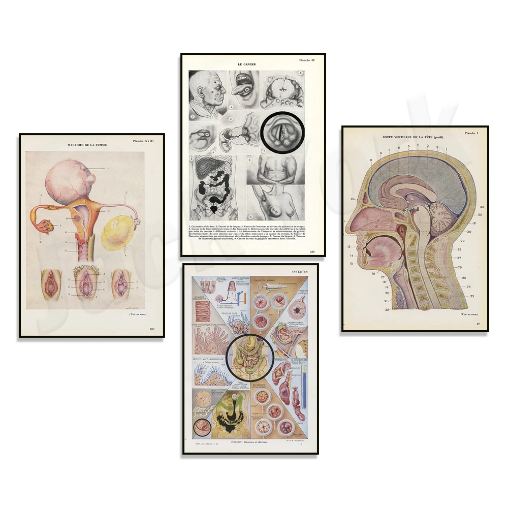 Female genitalia model, intestinal medical anatomy, microcephaly anatomy, psoriasis dermatology poster, doctor medical gift