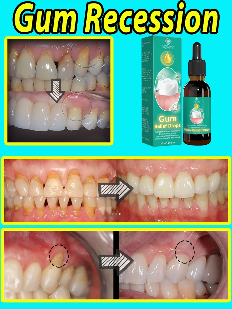 Effectively repair damaged gums, relieve toothache, strengthen teeth and strengthen gums Gᴜᴍ ʀᴇᴄᴇssɪᴏɴ,Gᴜᴍ ʀᴇsᴛᴏʀᴀᴛɪᴏɴ