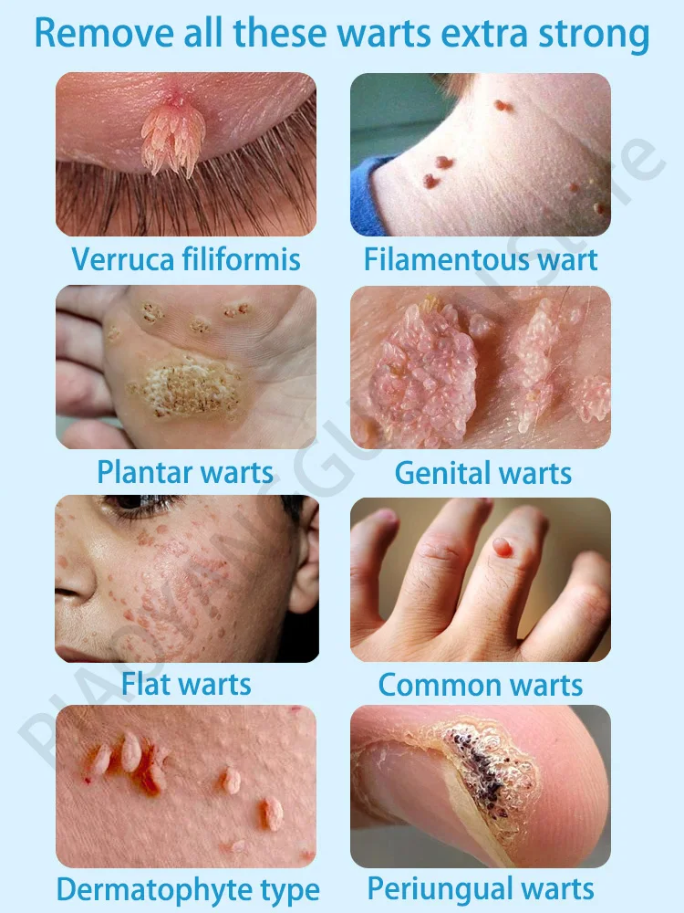 Warts-Removal