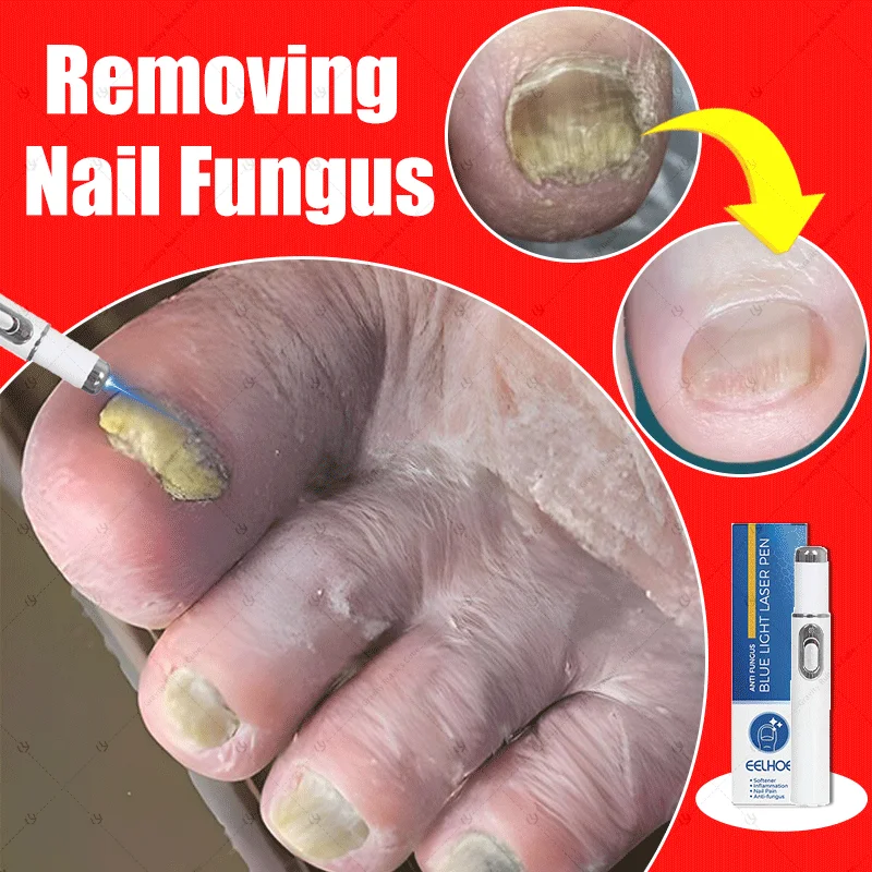 

"laser for nail fungus "