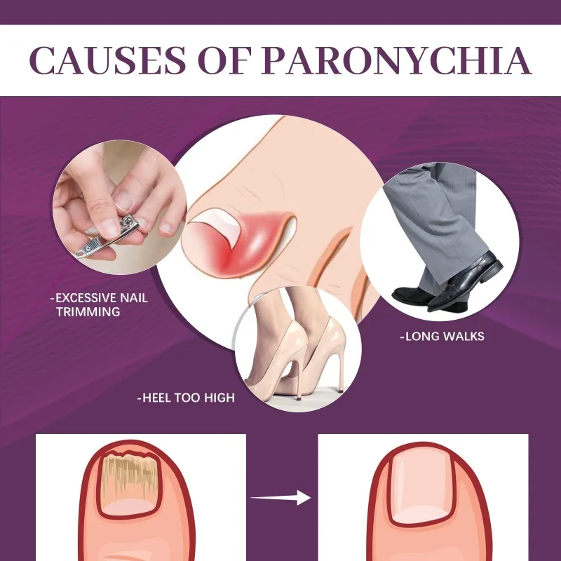 สติกเกอร์แก้ไขเล็บเท้าป้องกันการติดเชื้อเชื้อรา paronychia การรักษาเท้านิ้วหัวแม่มือกำจัดขนคุด