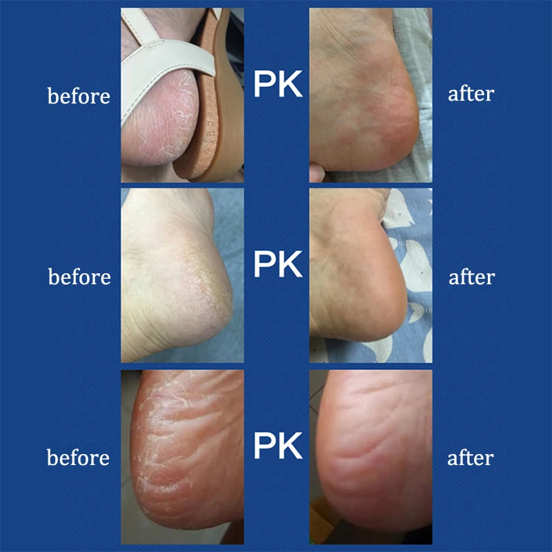 Elektrische Voet Grinder Artefact Te Verwijderen Dode Huid Machine Usb Oplaadbare Voetverzorging Tool Huishoudelijke Voet Gebarsten Schoon Gereedschap