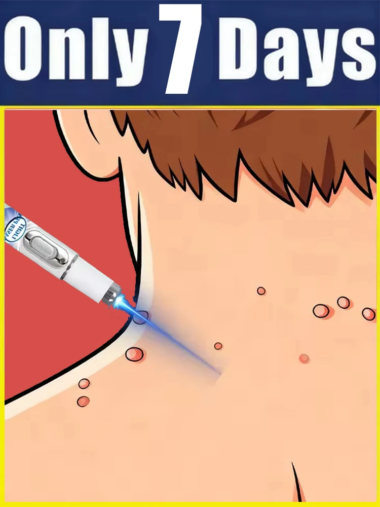 

Устройство второго поколения, подходит как мужчинам, так и женщинам, для удаления бородавок на лице, теле и шее, средство для ухода за кожей, инструмент для лечения бородавок.