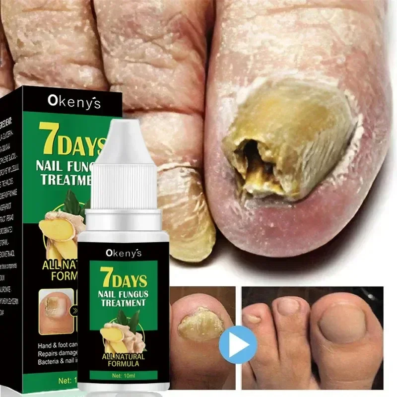 Fungustreatment de uñas Extra fuerte, esencia para el cuidado de los pies, reparación de aceite, esencia para el cuidado de los pies, antiinfección, paroniquia, onicomicosis