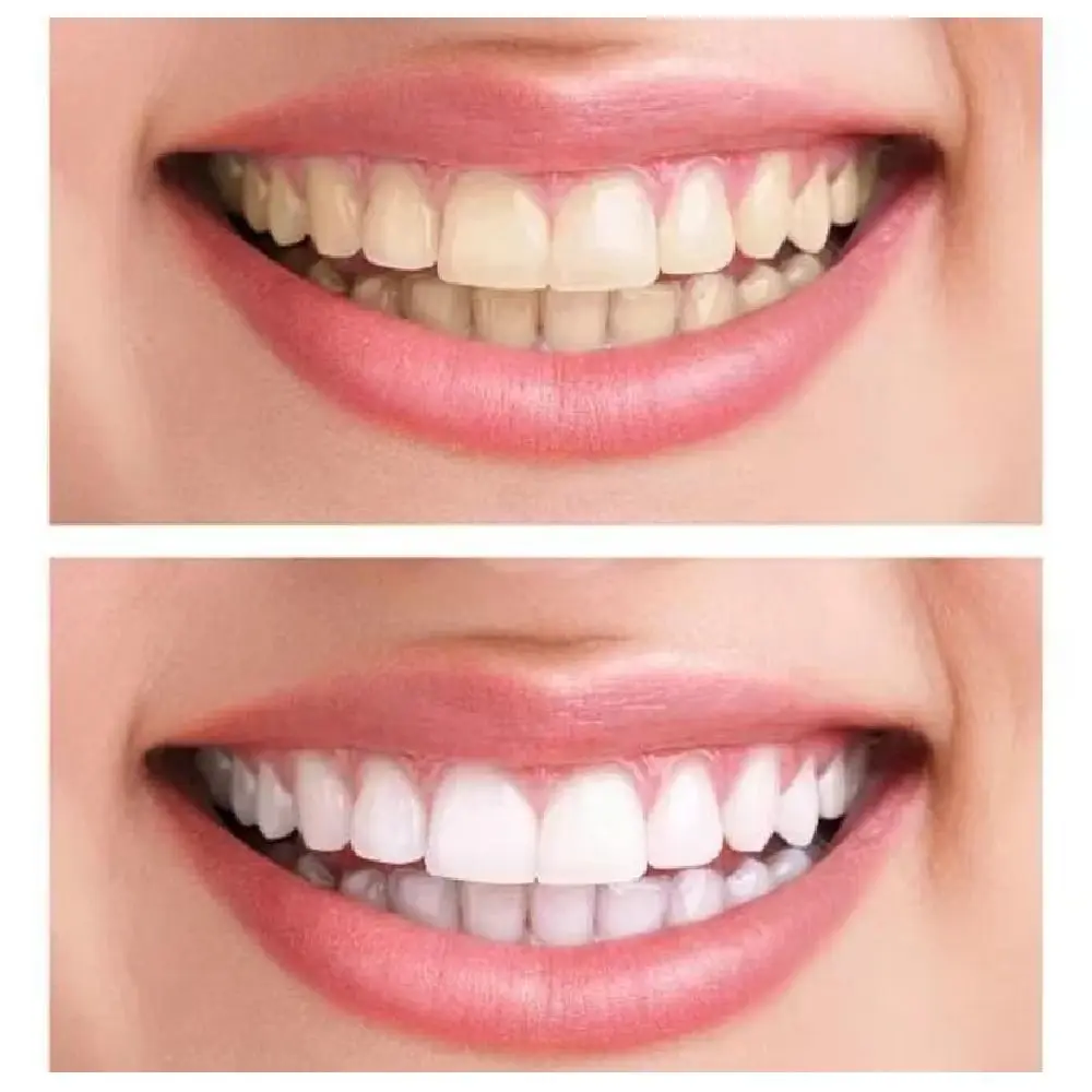 DIY Silicone False Teeth Confident Smile Whitening Temporary Fake Tooth Realistic with Filling Teeth Glue Cosmetic Dental Veneer