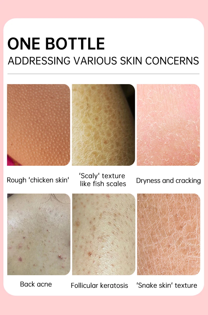 ครีมบำรุงผิว60กรัมครีมบำรุงผิวไก่ Keratosis Pilaris โลชั่นเพิ่มความชุ่มชื้นดูแลรูขุมขนเป็นหลุมเป็นบ่อ