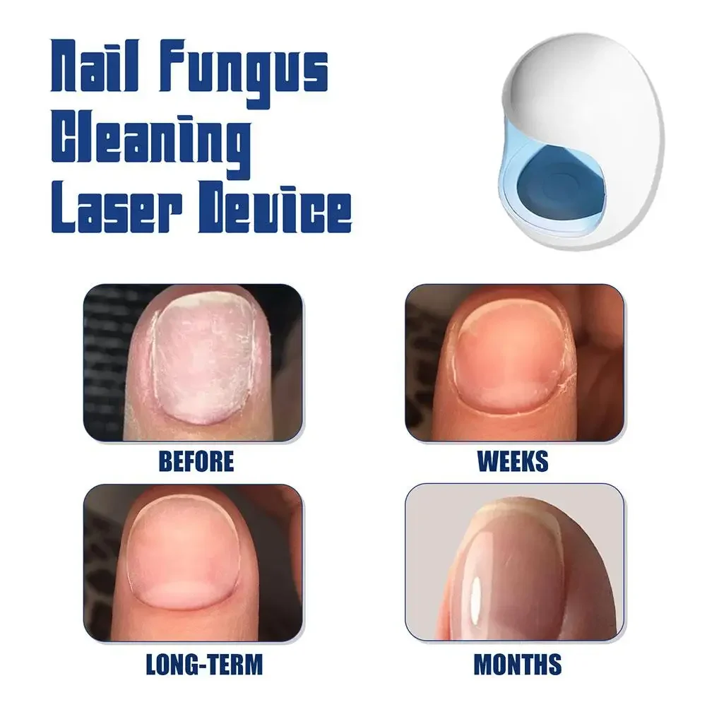 Appareil laser fongique pour ongles, champignon des ongles, machine de traitement au laser, réparation des ongles avec onychomycose, pièces plus lentes, traitement au laser des doigts