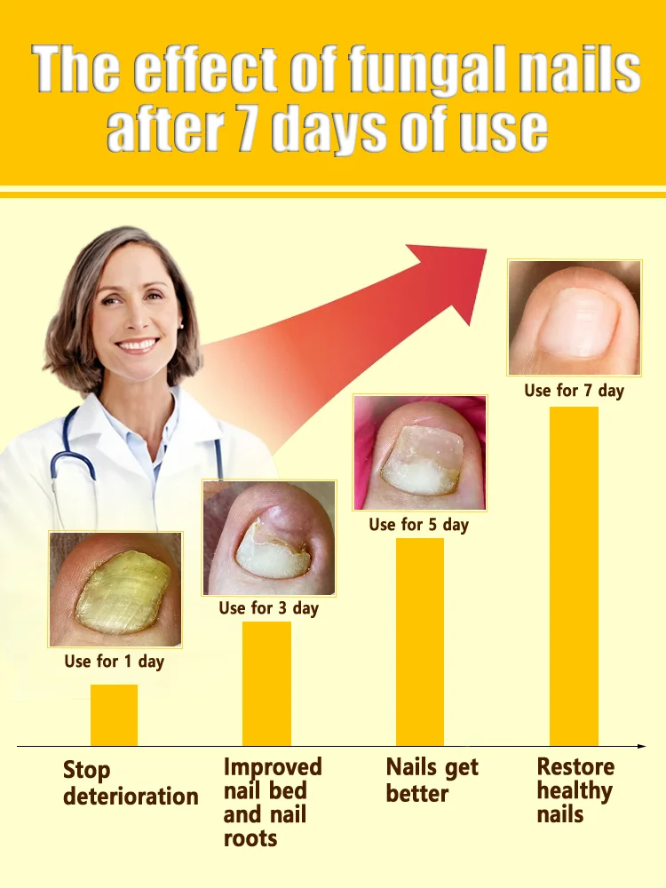The most powerful black technology in 2024 will completely solve the problem of nail mold!