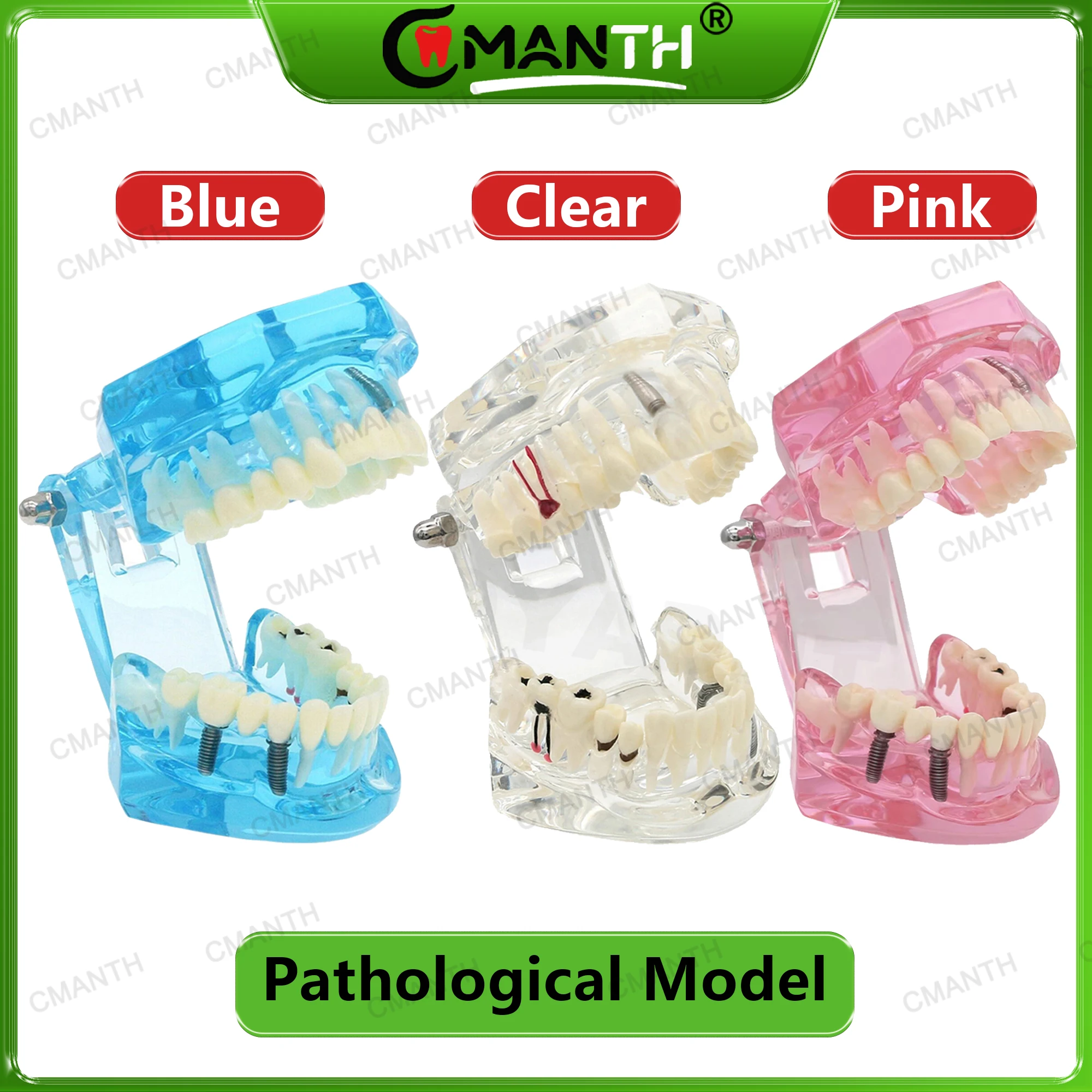 

Dental Models Disease Tooth Model Typodont Implant With Removable Tooth Restoration Bridge Teaching Research Tooth Model
