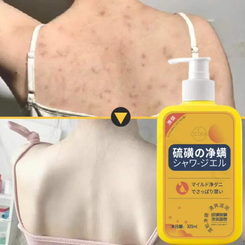 Sulfur Mite Removal Liquid Soap Back Whole Body Cleansing, Anti-itch, Oil Control, Anti-acne Mite Moisturizing Shower Gel