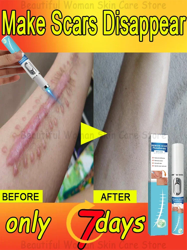 Hot Selling Laser Repair Skin Scars