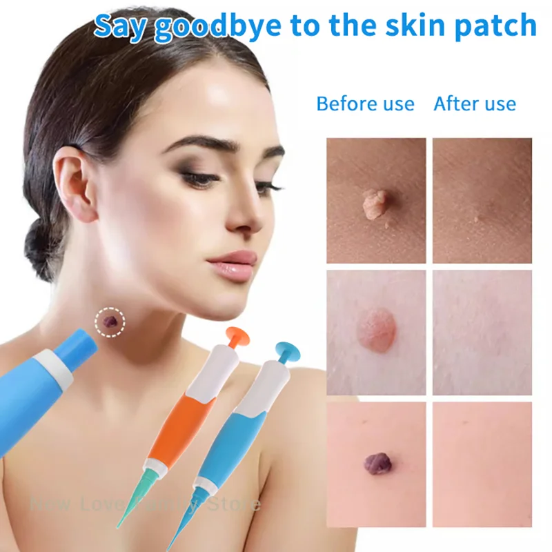 Auto Skin Tag Removal Kit 1-8mm Band Painless Mole Wart Skin Tag Remover Pen Wart Dot Corn Treatments Body Facial Beauty Tool