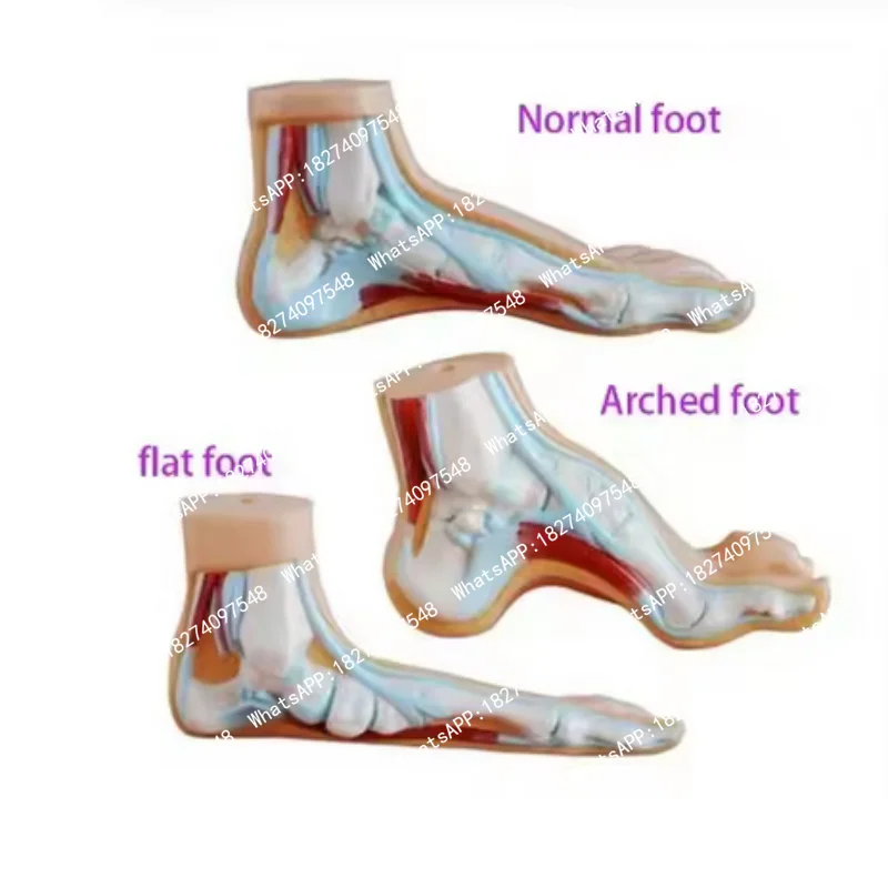 Foot Pathology Model Normal/Flat/High Arch Foot Anatomy with Muscles Bones Medical Teaching Display for Podiatry Education