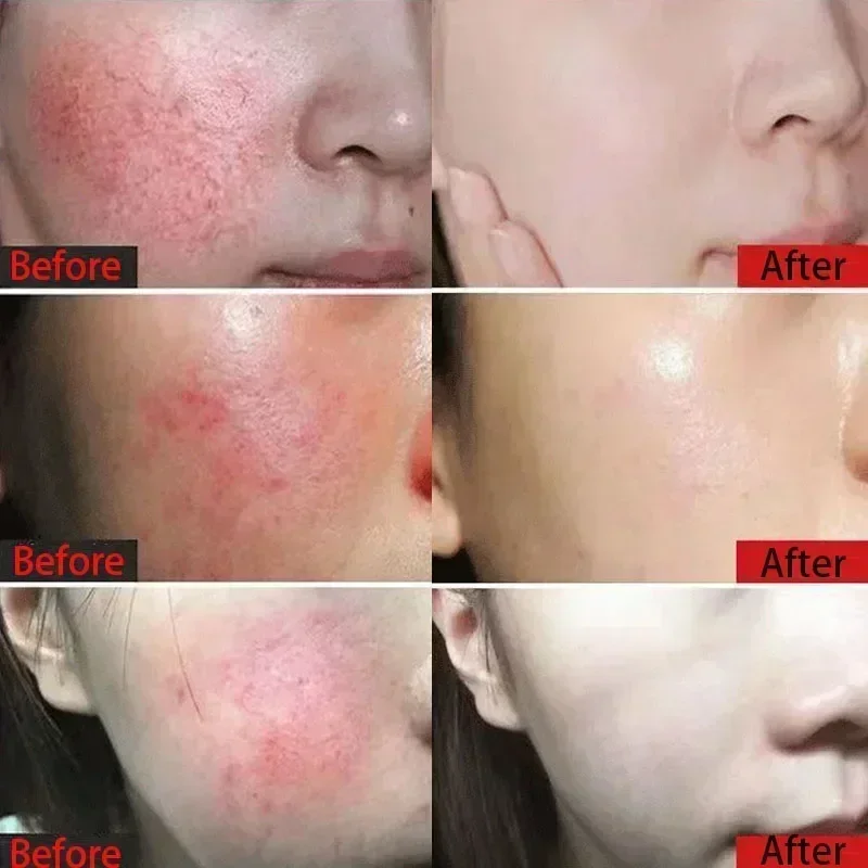 Reparação de vermelhidão facial creme calmante vermelhidão 7 dias reparação da pele rosácea sangue vermelho melhorar cuidados com a pele sensível cosméticos coreanos