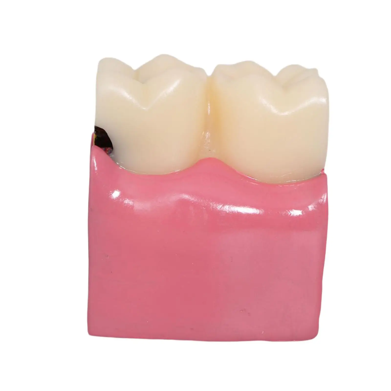 

6 Times Education Supplies Oral Preventive Care Tooth Decay Model Demonstration Tooth Model Tooth Teaching Display for Studying