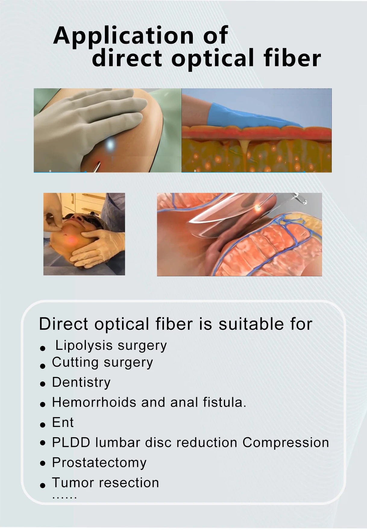 High-quality 3-meter Sterile SMA905 Optical Fiber, 200um Optical Fiber