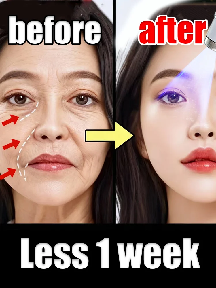 

Laser pointer tools use blue light to deeply reshape facial contours.