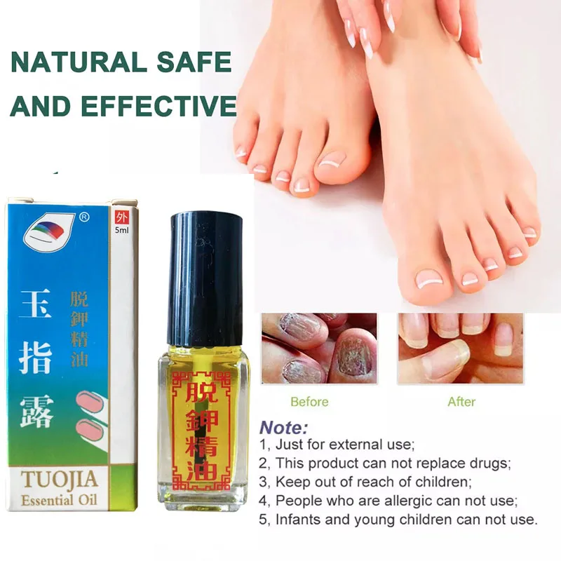 เอสเซนส์รักษาเชื้อราเล็บ 7 วัน น้ำมันหอมระเหยกำจัดเชื้อราเล็บเท้า ป้องกันการติดเชื้อ รักษาเล็บขบและเล็บอักเสบ