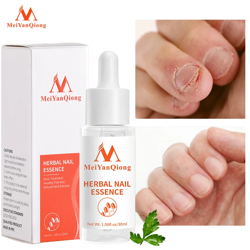 Nail Treatment Feet Care Essence Nail Foot Whitening Toe Nail Fungus Removal Gel Anti Infection Paronychia Onychomycosis