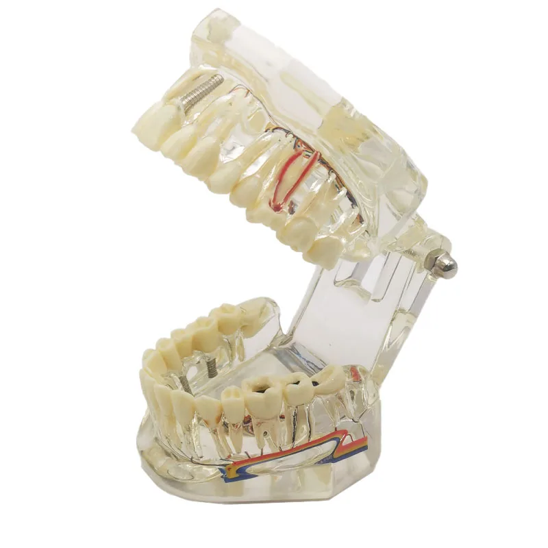 Dental Implant Model Teeth Neural Repair Resin Models Of Diseased Teeth for Dentist  Teaching and Research In Dental Diseases