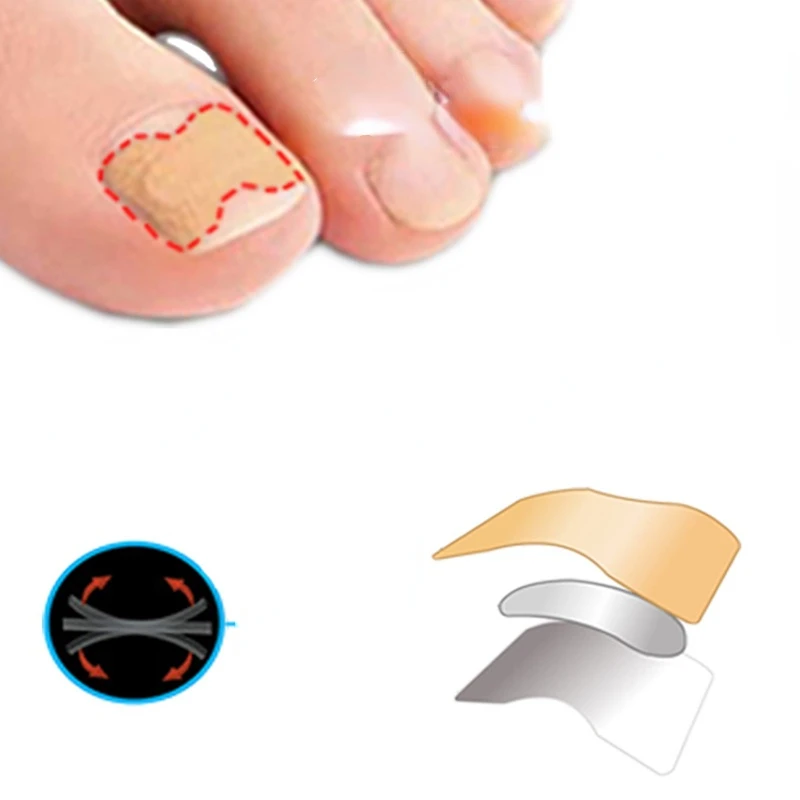 Nail Correction Stickers Paronychia Treatment Recover Corrector Pedicure Tools