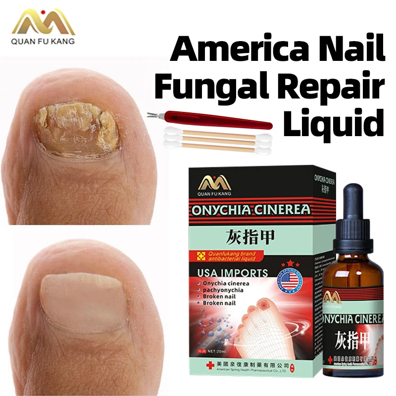 

Fungal Nail Treatment Liquid Nail Correction Onychomycosis Toe Fungus Medicine Paronychia Cleaner Foot Care American Formula