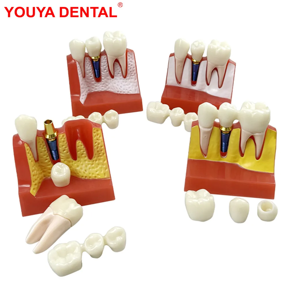 Cheap 4 Time Dental Implant Model Dentistry Resin Removable Teeth Model Analysis Crown Bridge Demostration For Teaching Studying